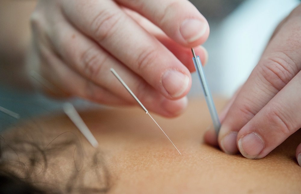 Dry Needling  Edmonton, KY 